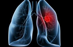 Akciğer Kanserine Karşı Ne Tür Tedbirler Alınabilir?